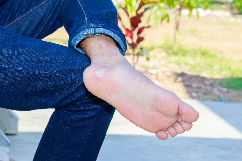 What are plantar warts?