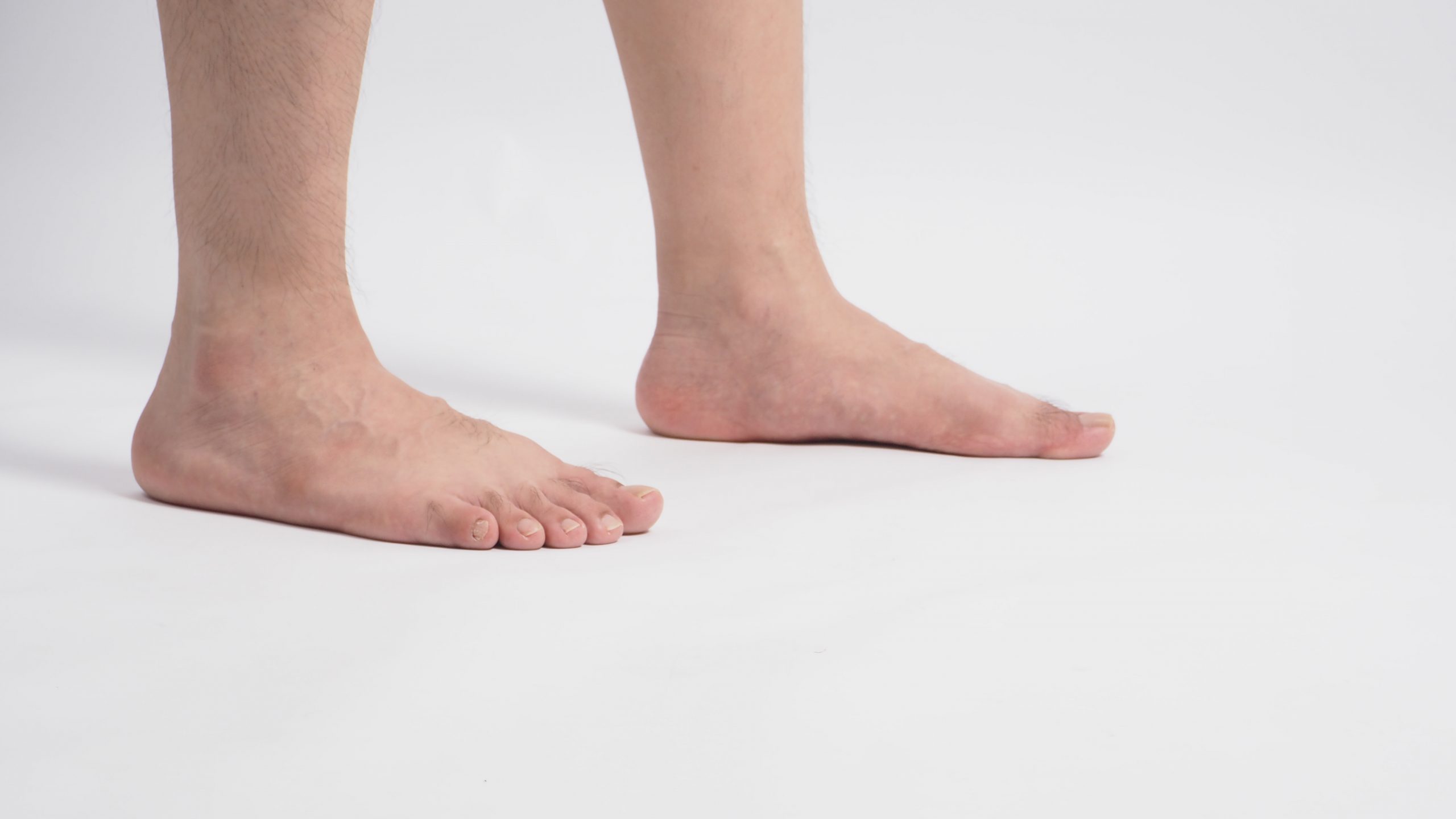 Flat feet 