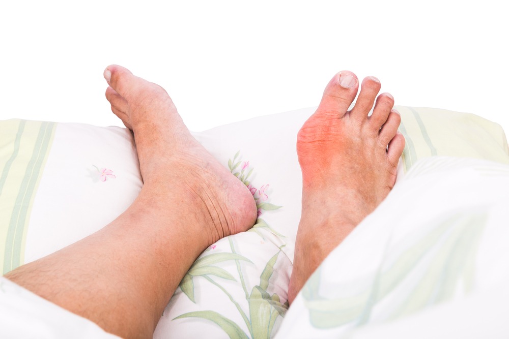 Foot arthritis and osteoarthritis